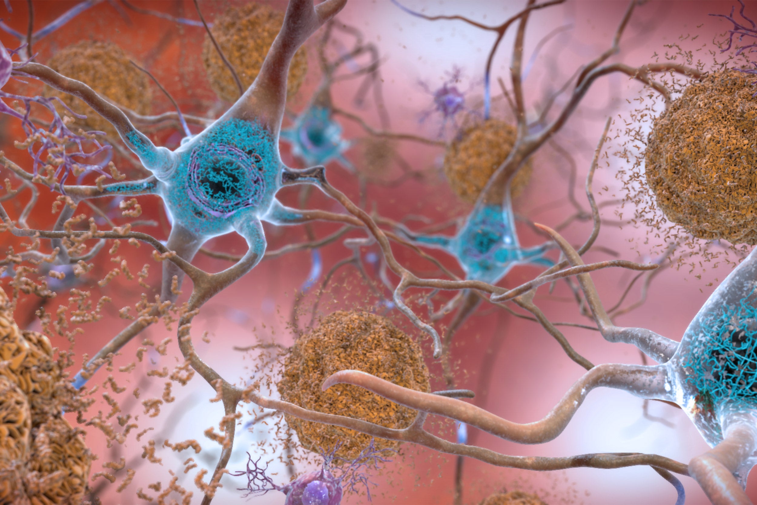 This illustration shows the two main forms of disruptive protein clumps found in the brains of people with Alzheimer’s disease: