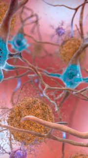 Start of new era for Alzheimer’s treatment